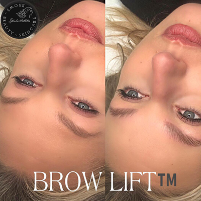 Brow Lift before and after