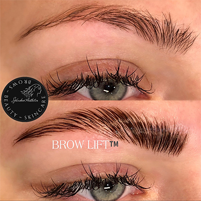 Brow Lift before and after